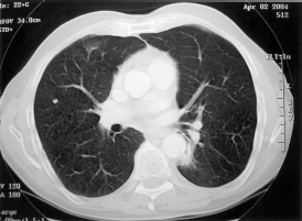 MFH sarcoma in lungs omega 3